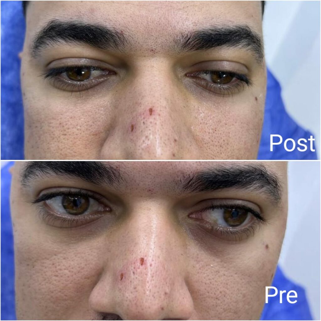 Filler under men before and after